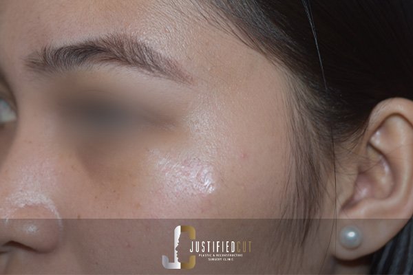 Justified Cut After Hemangioma Surgery 1