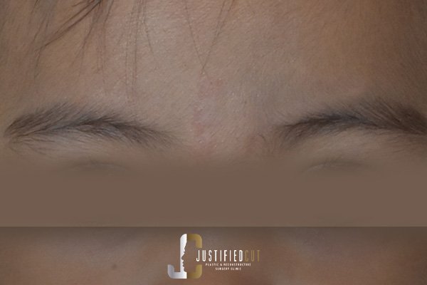 Justified Cut After Hemangioma Surgery