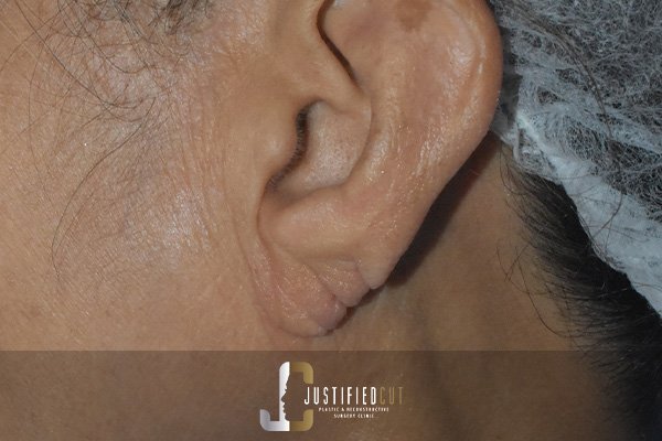 Justified Cut After Earlobe Repair