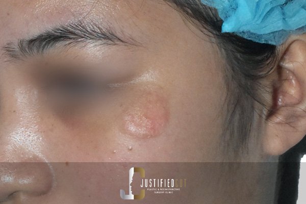 Justified Cut Before Hemangioma Surgery 1