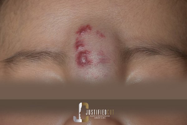 Justified Cut Before Hemangioma Surgery