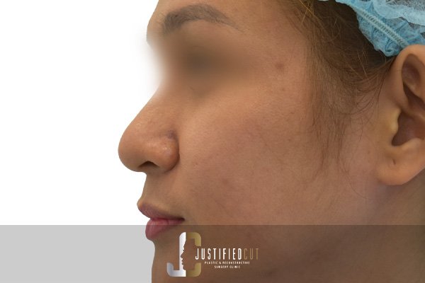 Justified Cut Before Tiplasty