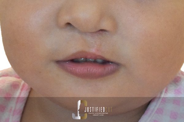 Justified Cut Cleft Lip After
