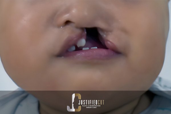 Justified Cut Cleft Lip Before