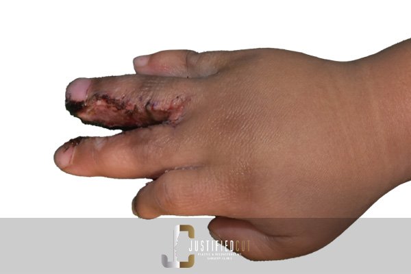 Justified Cut Syndactly 2