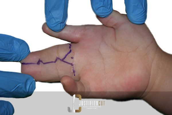 Justified Cut Syndactly 3
