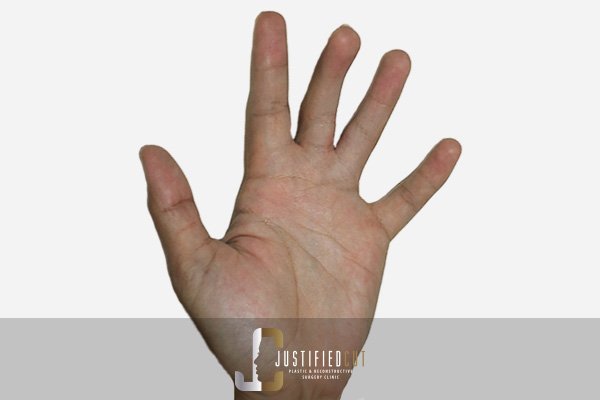 Justified Cut Syndactyly After