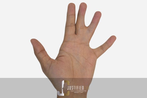 Justified Cut Syndactyly Before