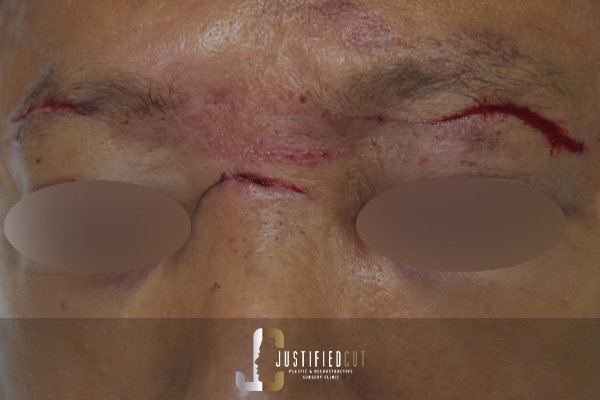 Justified Cut Before Facial Laceration Surgery PX2