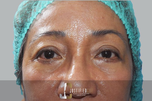 Justified Cut After Lower Bleph