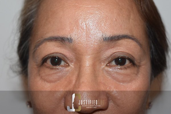 Justified Cut Before Lower Bleph